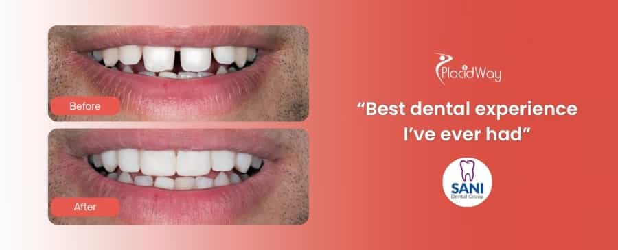 Procedimiento Dental en Sani Dental Group Los Algodones, México
