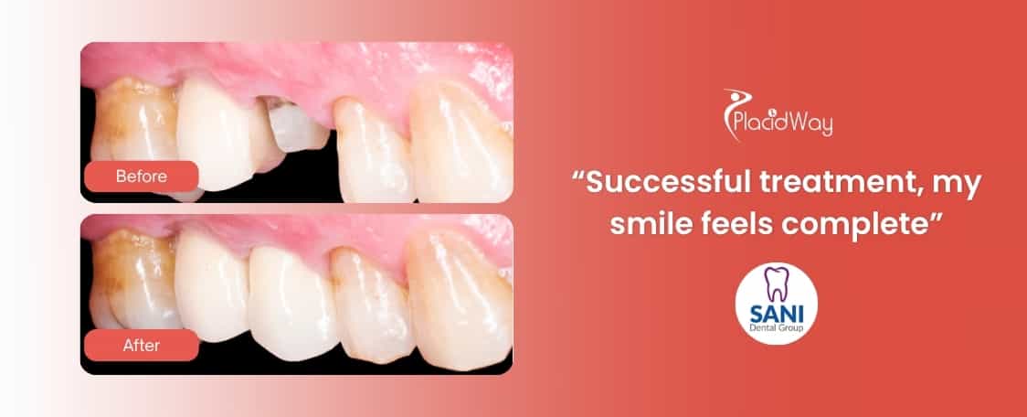 Dental Procedure at Sani Dental Group Los Algodones, Mexico