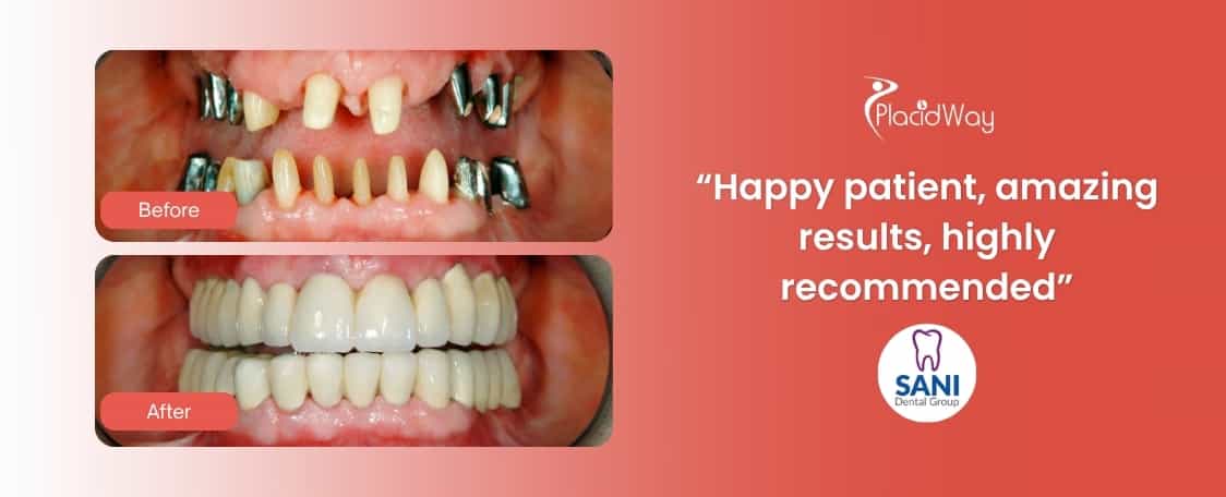 Dental Implants in Los Algodones