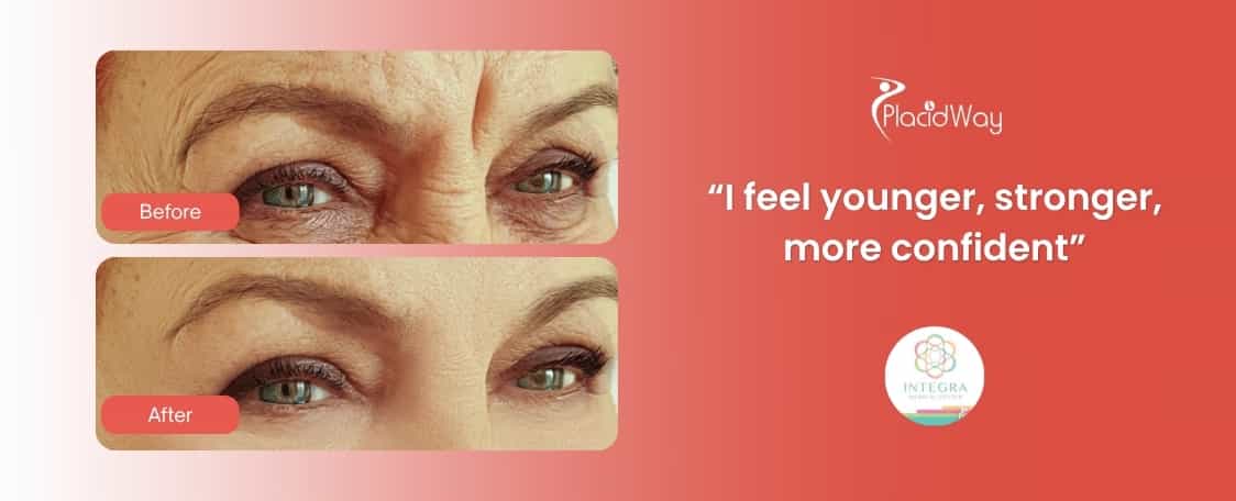 Anti-Aging Treatment in Mexico