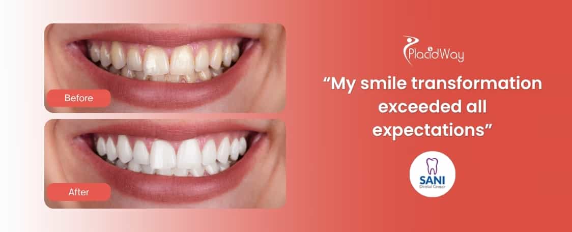 Dental Procedure in Sani Dental Group, Mexico