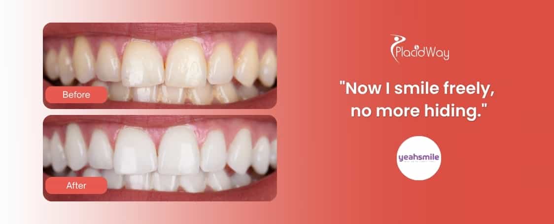 Blanqueamiento dental en Cancún, México