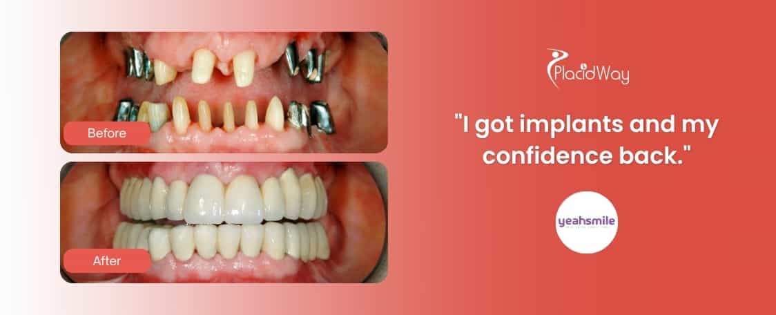 Dental Implant in Mexico