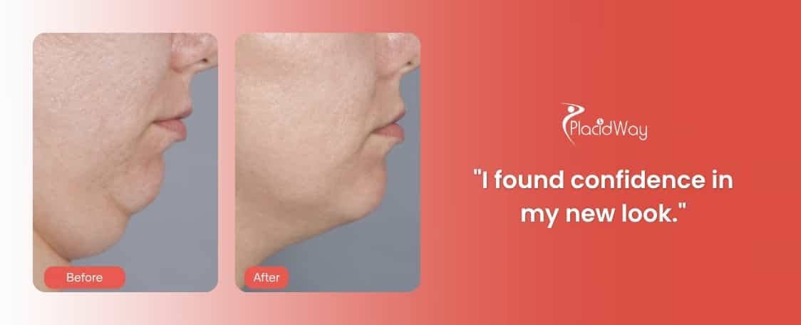 Chin Implant Procedures at New Me Clinic in Dubai, UAE