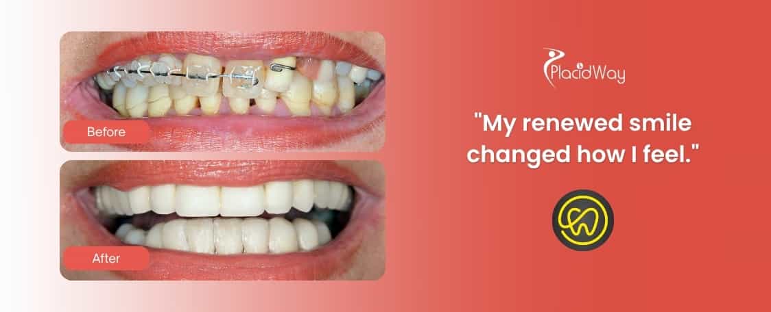 Implantes dentales en Estambul, Turquía