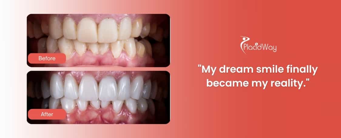 Dental Veneers in Costa Rica