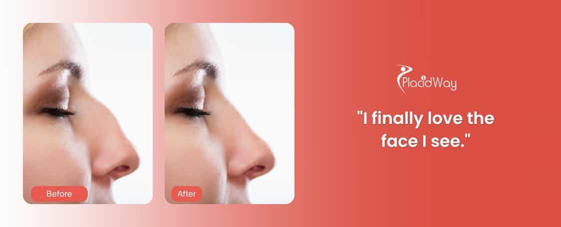 Rhinoplasty Before and After Images in Merida, Mexico