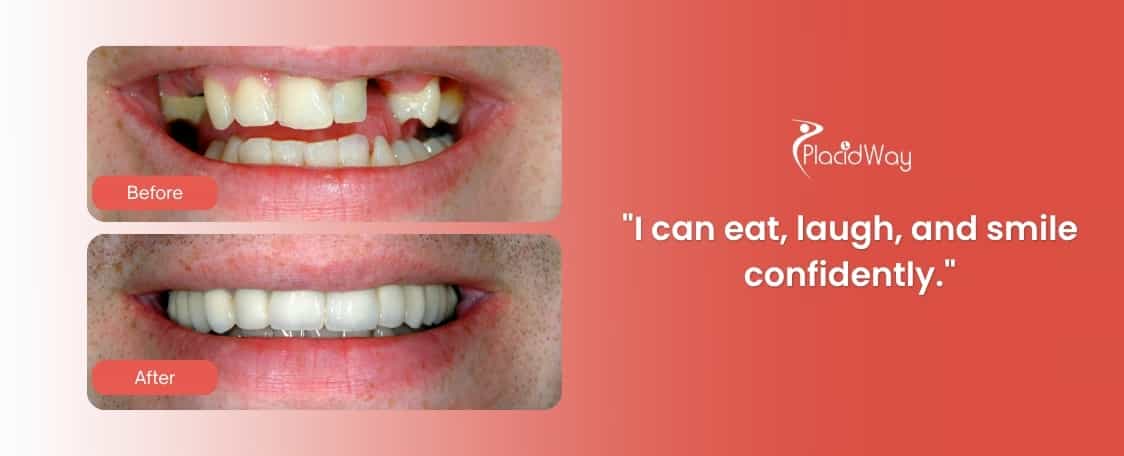 All-on-6 Dental Implants in Costa Rica