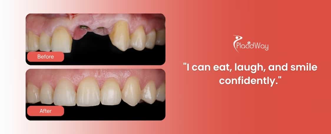 All-on-4 Dental Implants in Costa Rica