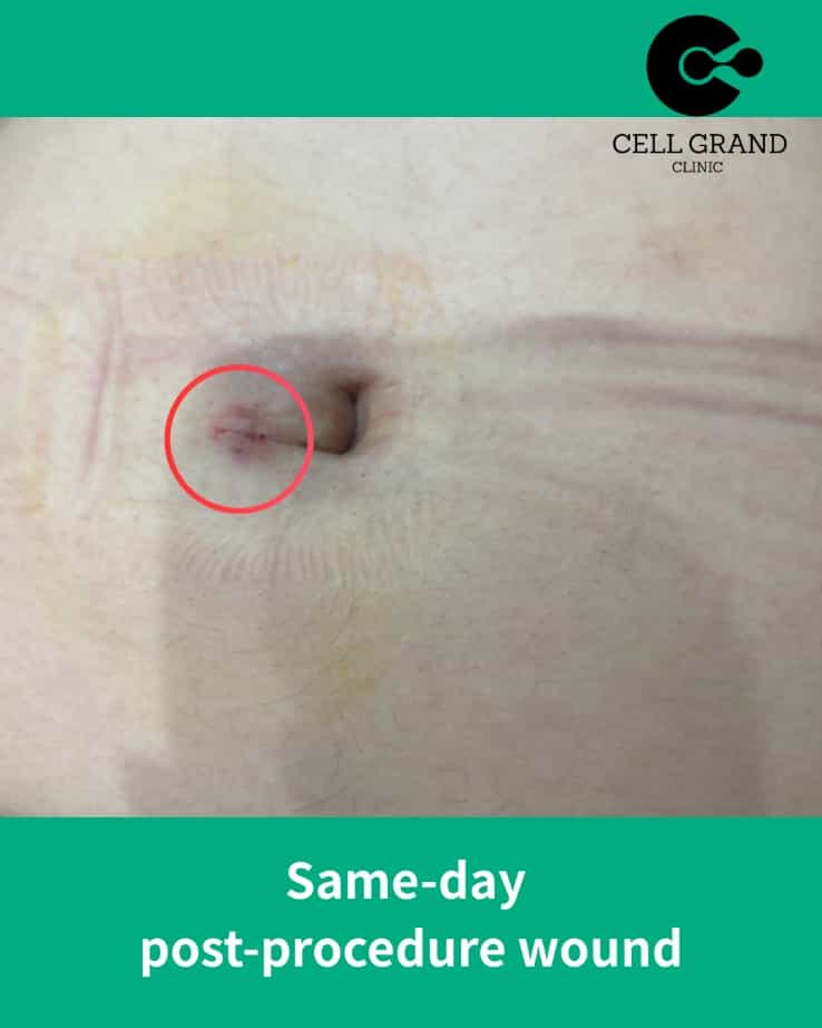 Japan Stem Cell Therapy