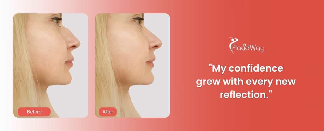 Rhinoplasty in Mexicali, Mexico