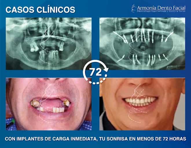 Full Mouth Restoration in Bogota Colombia Before After