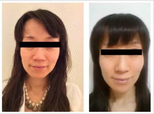 Stem Cell Therapy for Facial Rejuvenation in Tokyo Japan