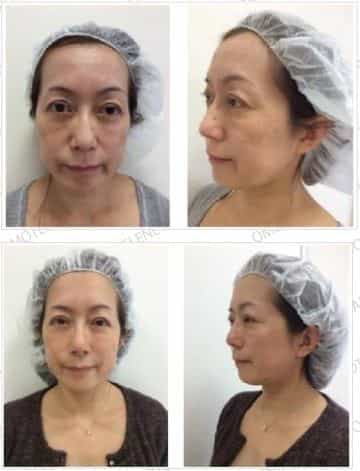 Stem Cell Facial Rejuvenation in Tokyo Japan Patient Review