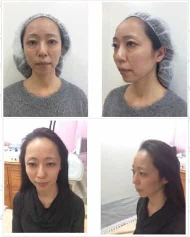 Stem Cell Therapy for Facial Rejuvenation in Tokyo