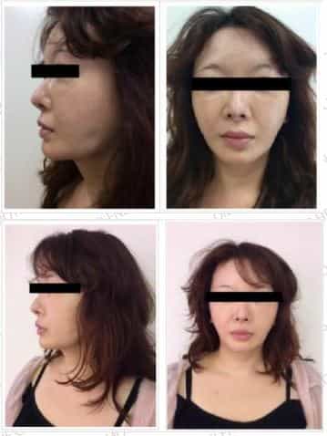 Stem Cell Facial Treatment in Japan