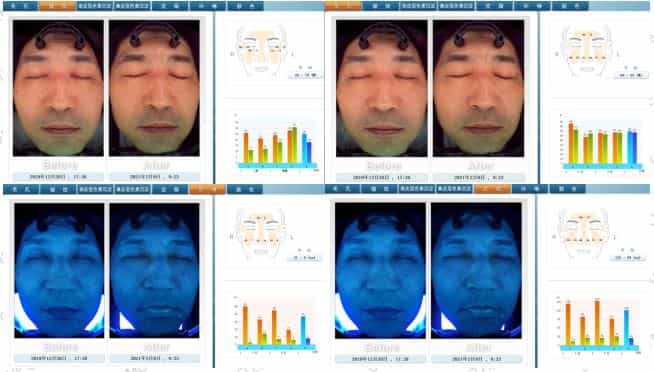 Facial Rejuvenation Therapy in Japan