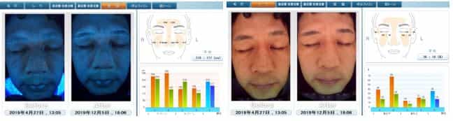 Regenerative Facial Therapy in Japan
