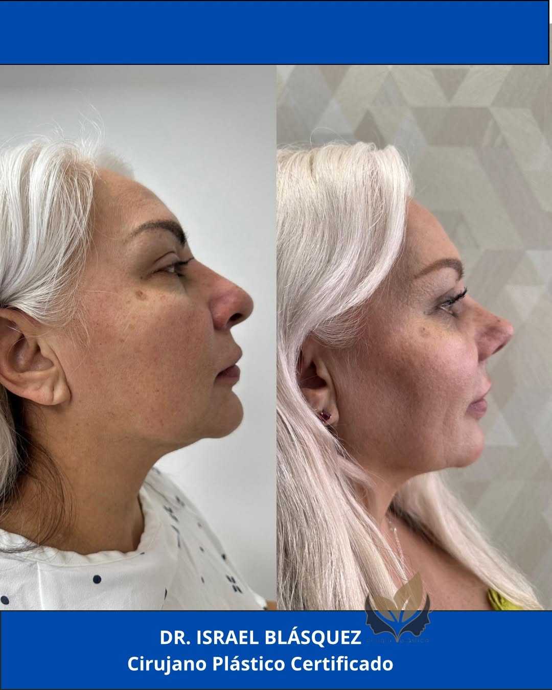 Before and After Image of Rhinoplasty in Tijuana Mexico