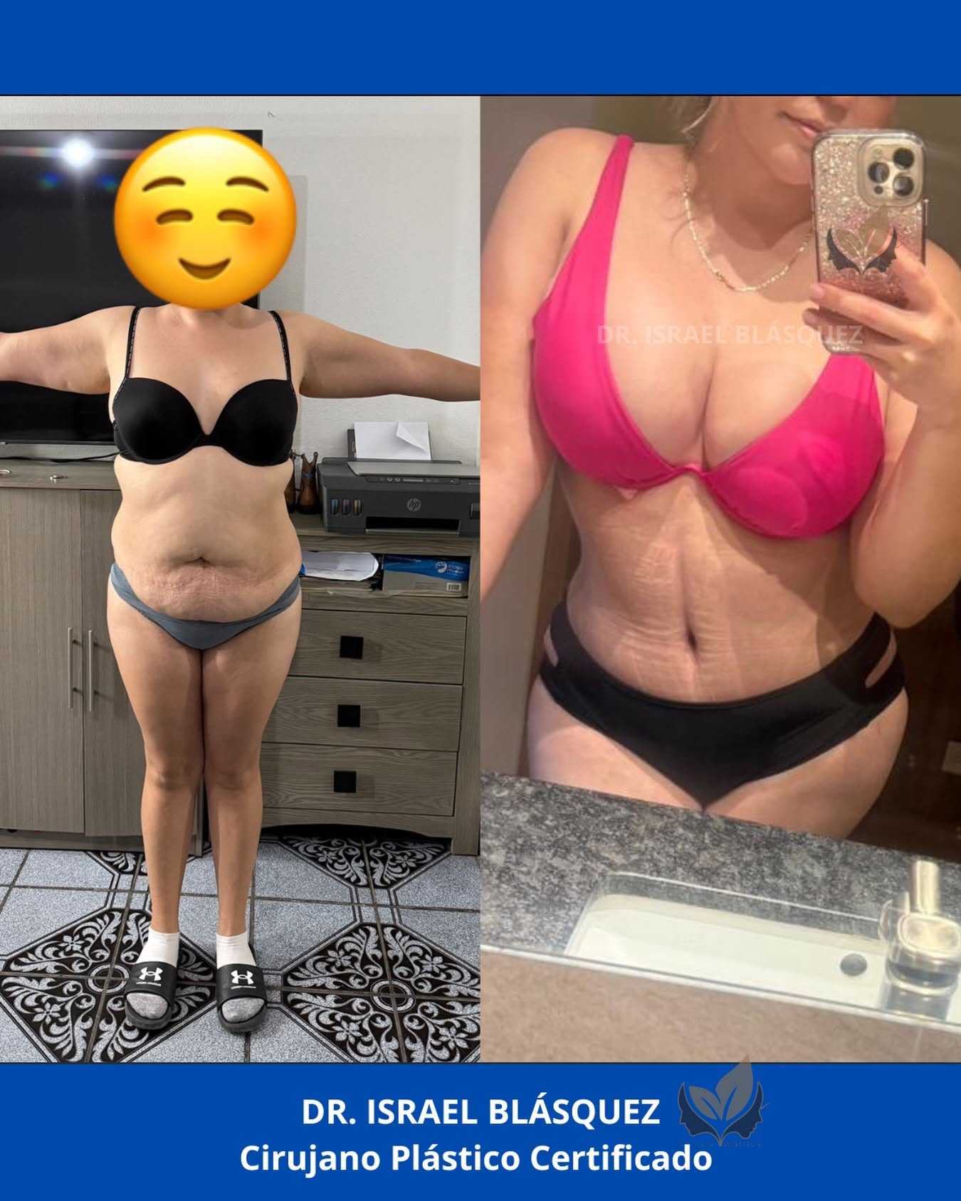 Before and After Image of Tummy Tuck in Tijuana Mexico