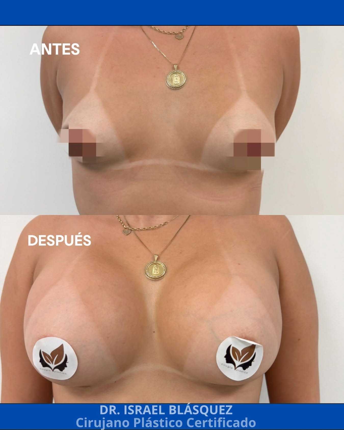 Before and After Image of Breast Augmentation in Tijuana Mexico