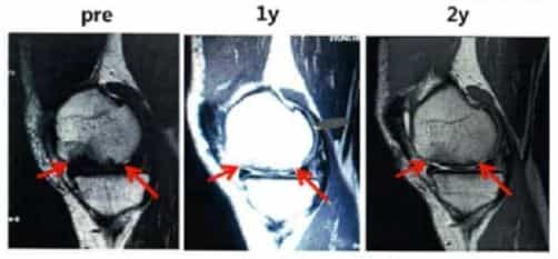 Stem Cell Therapy for Osteoarthritis Case 1