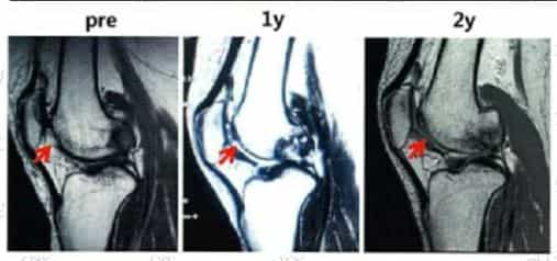 Stem Cell Knee Treatment Case 2