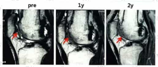 Osteoarthritis Treatment in Japan Case 3