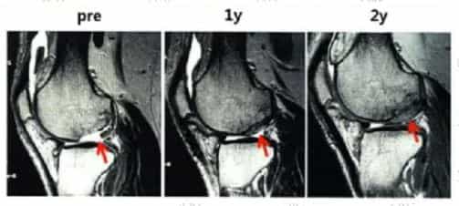 Osteoarthritis Regenerative Medicine Case 4
