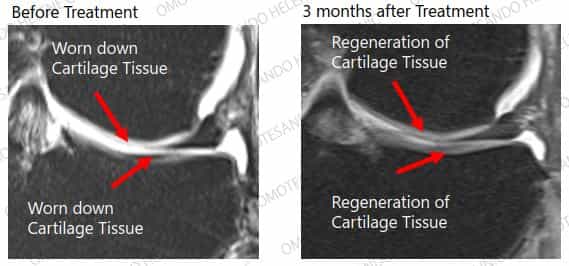 Knee Pain Stem Cell Therapy Case 5