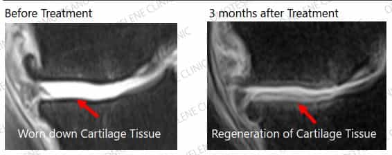 Stem Cell Therapy for Osteoarthritis Case 6