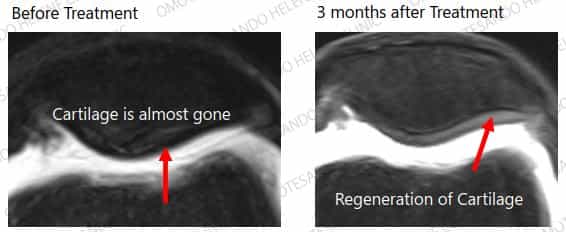 Stem Cell Knee Treatment Case 7