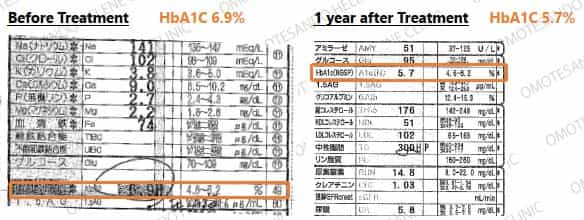 Diabetes Stem Cell Therapy in Japan Case 3 Experience