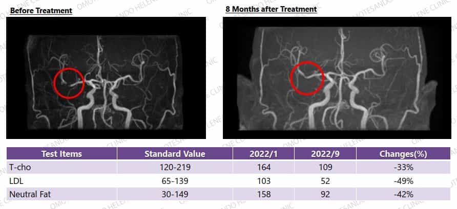 Vascular Regeneration Therapy in Japan