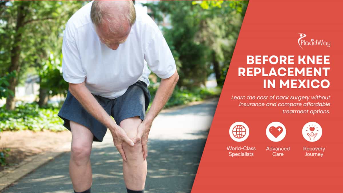 Knee Replacement Surgery in Mexico