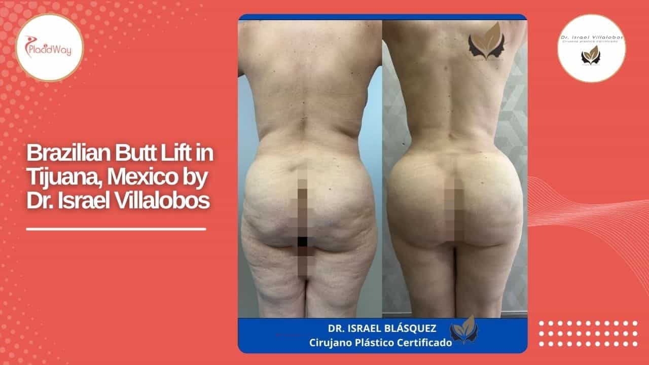 Brazilian Butt Lift in Tijuana Mexico
