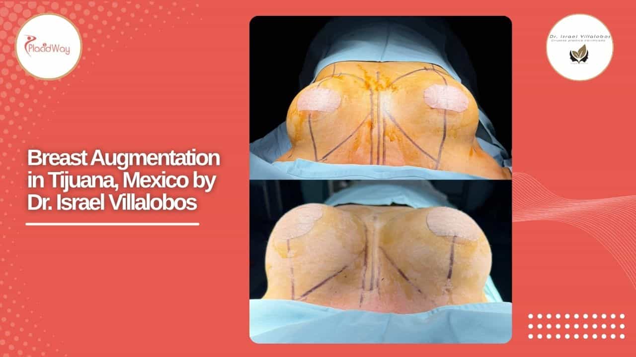 Breast Augmentation Result Case 1
