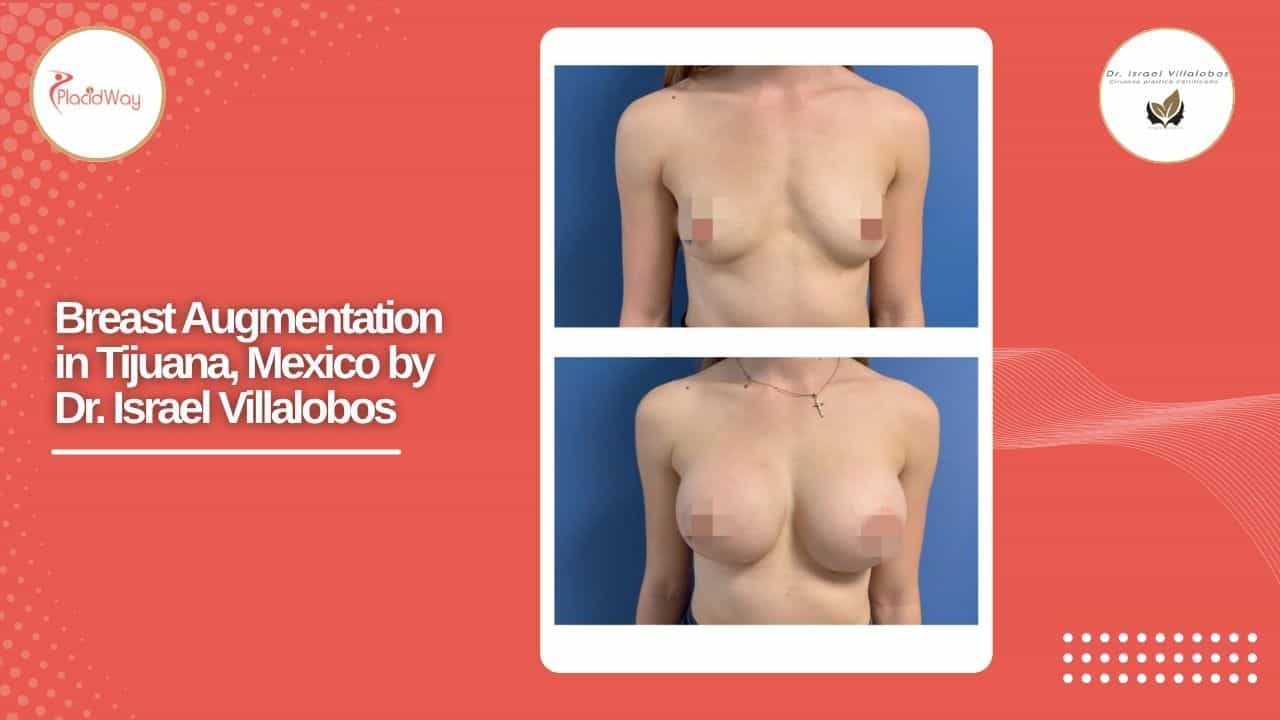 Breast Augmentation Result Case 2