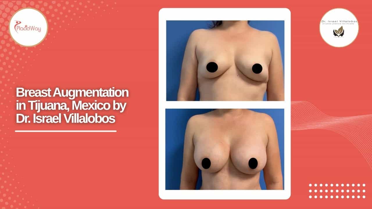 Breast Augmentation Result Case 3