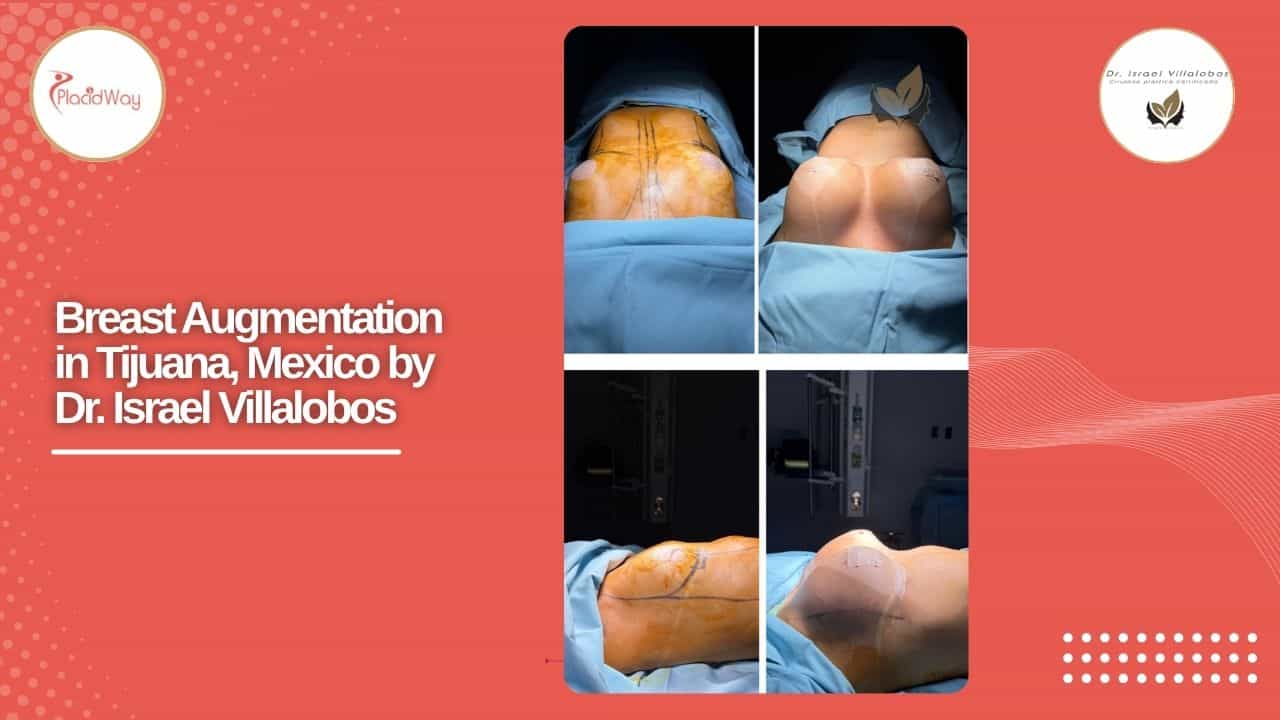 Breast Augmentation Result Case 4