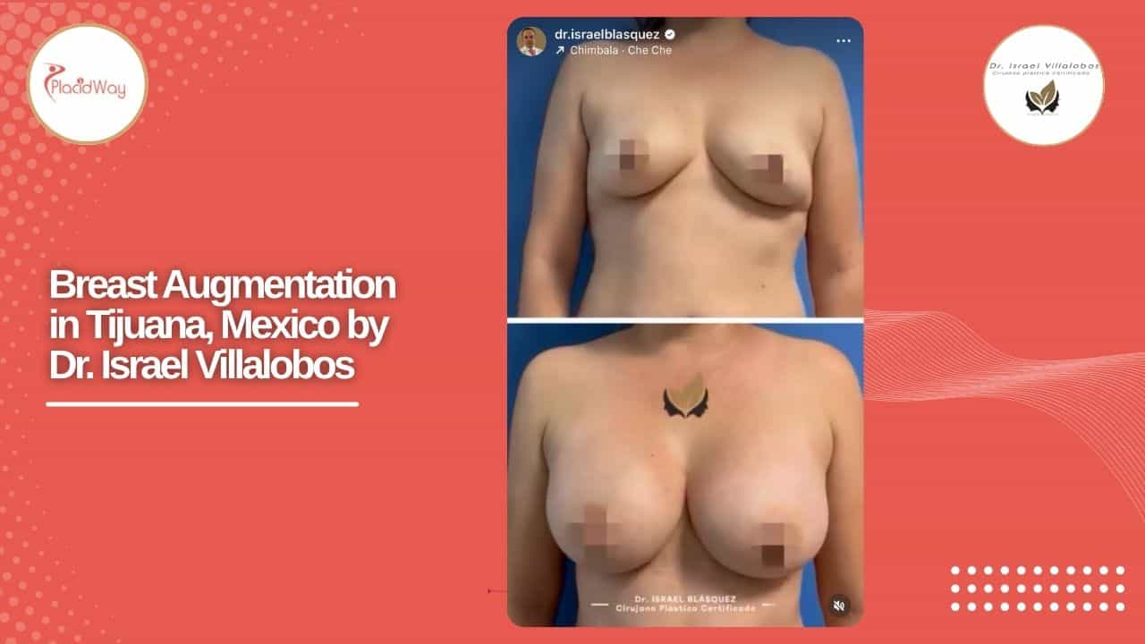 Breast Augmentation Result Case 6