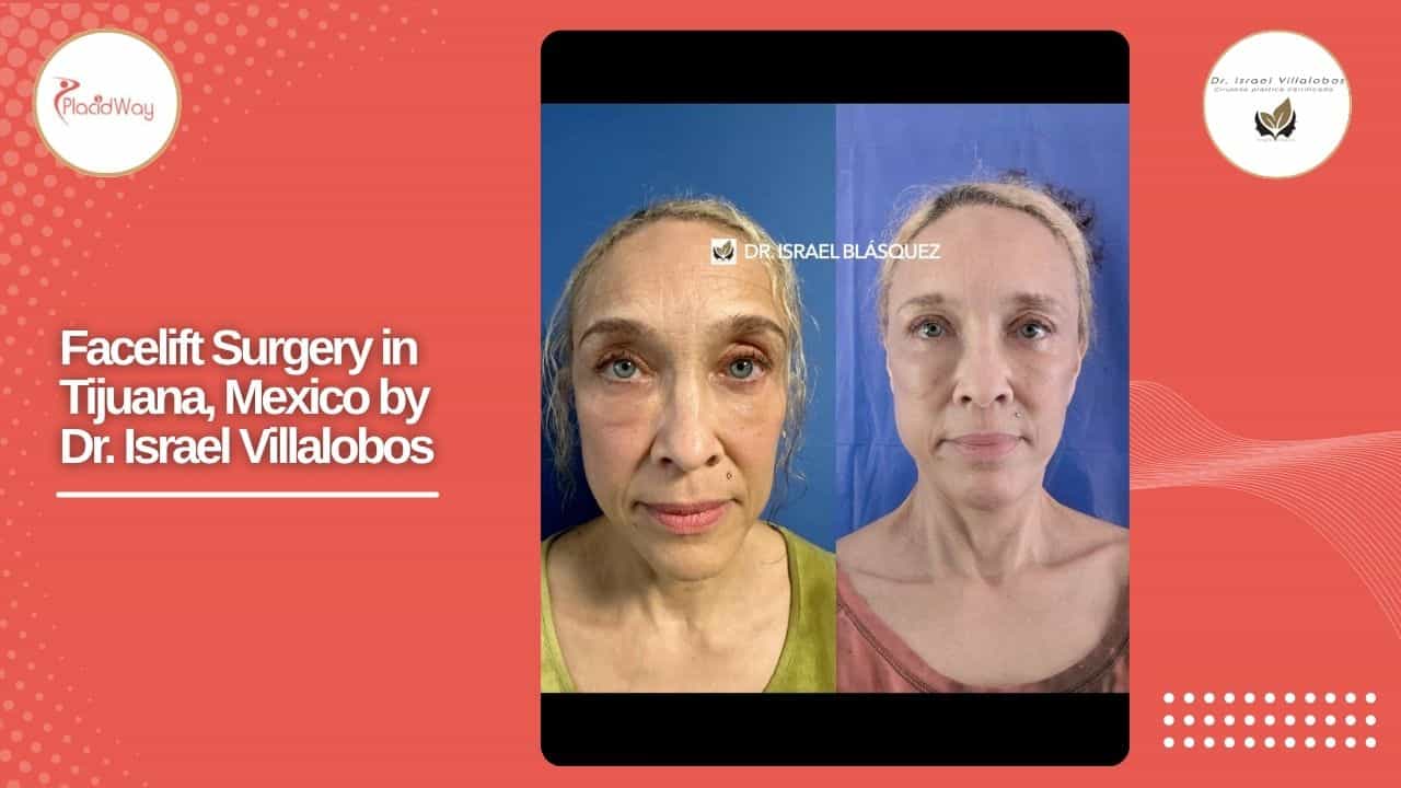 Facelift Before and After Result 1