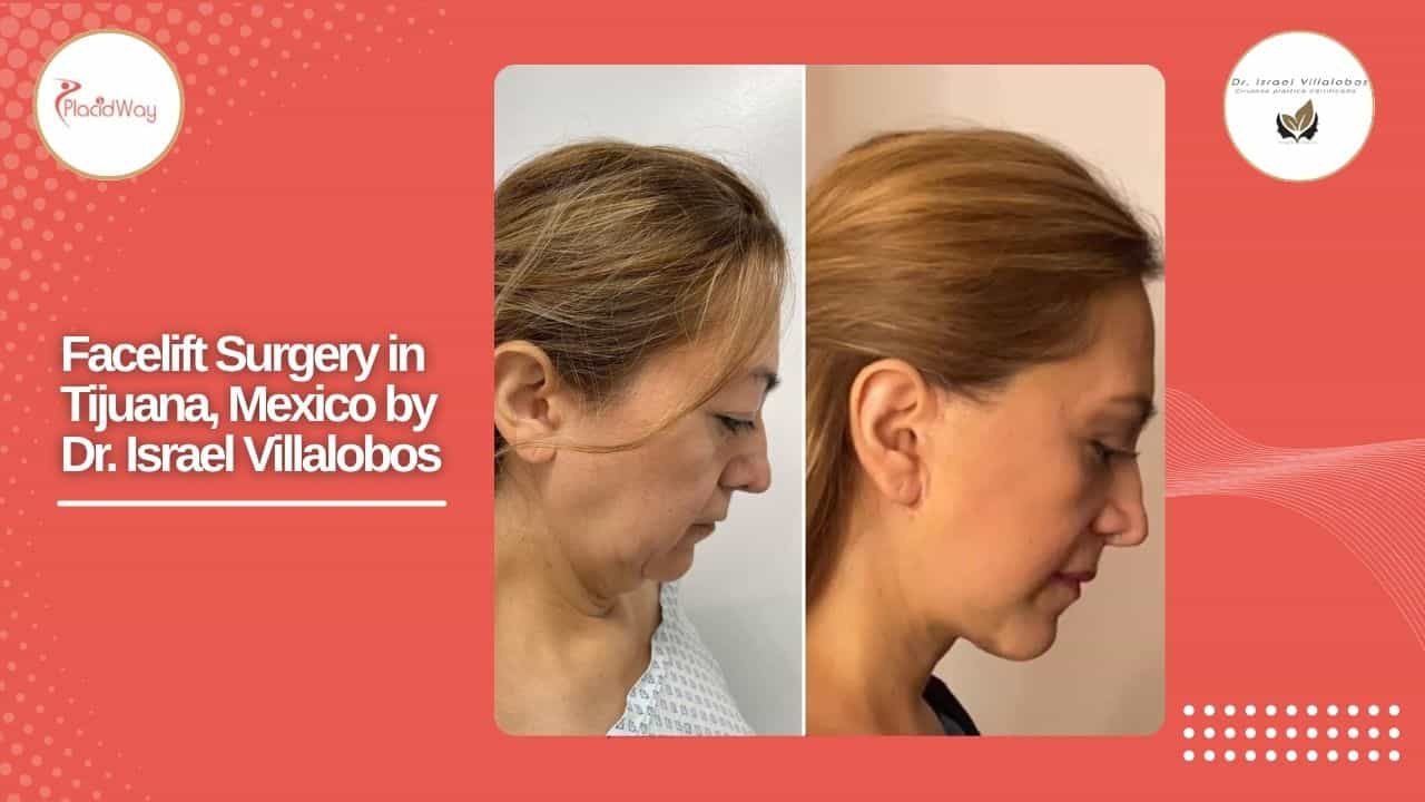 Facelift Before and After Result 2