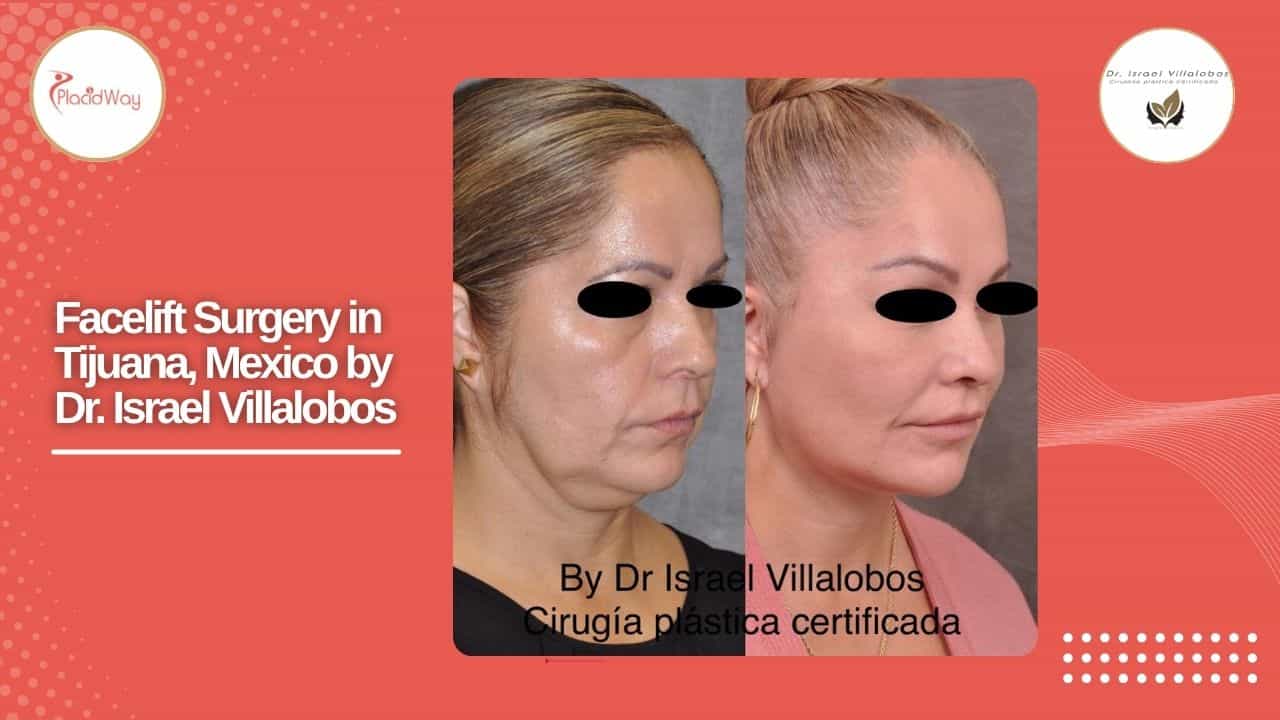 Facelift Before and After Result 3