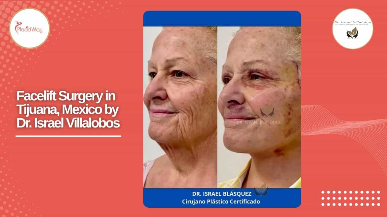 Facelift Before and After Result 4