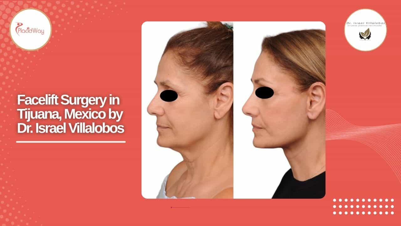 Facelift Before and After Result 5