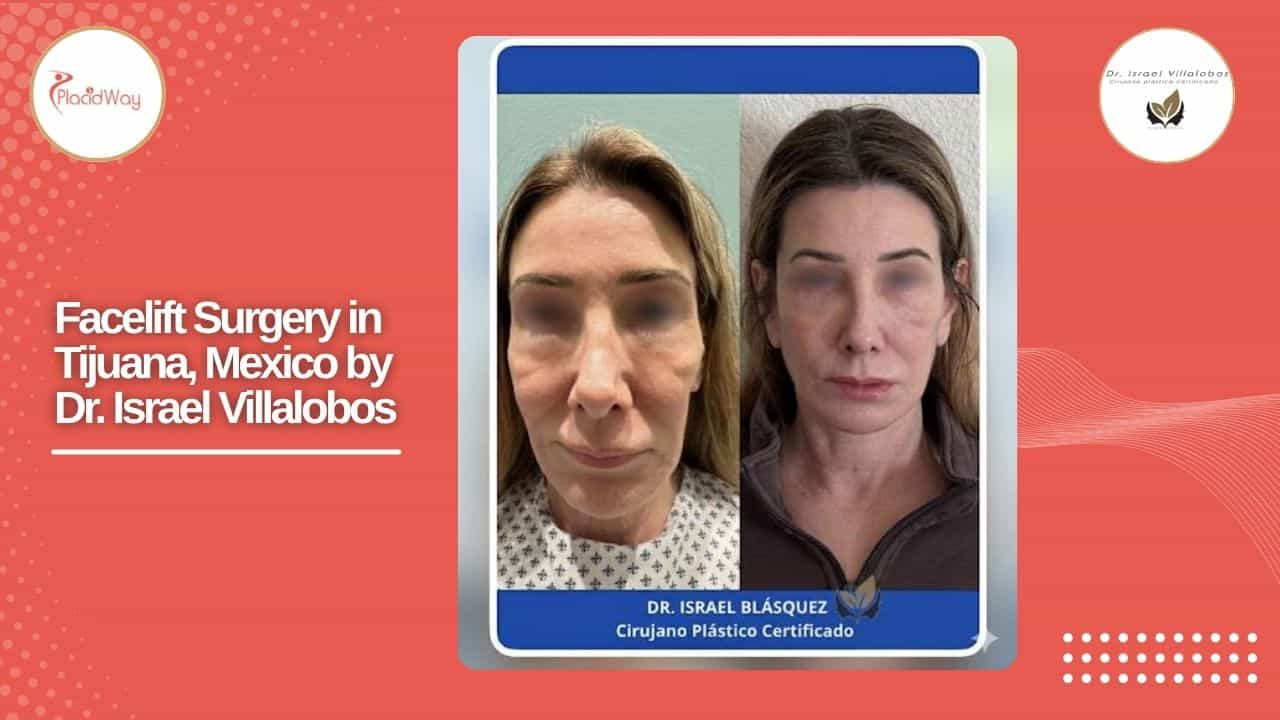 Facelift Before and After Result 6
