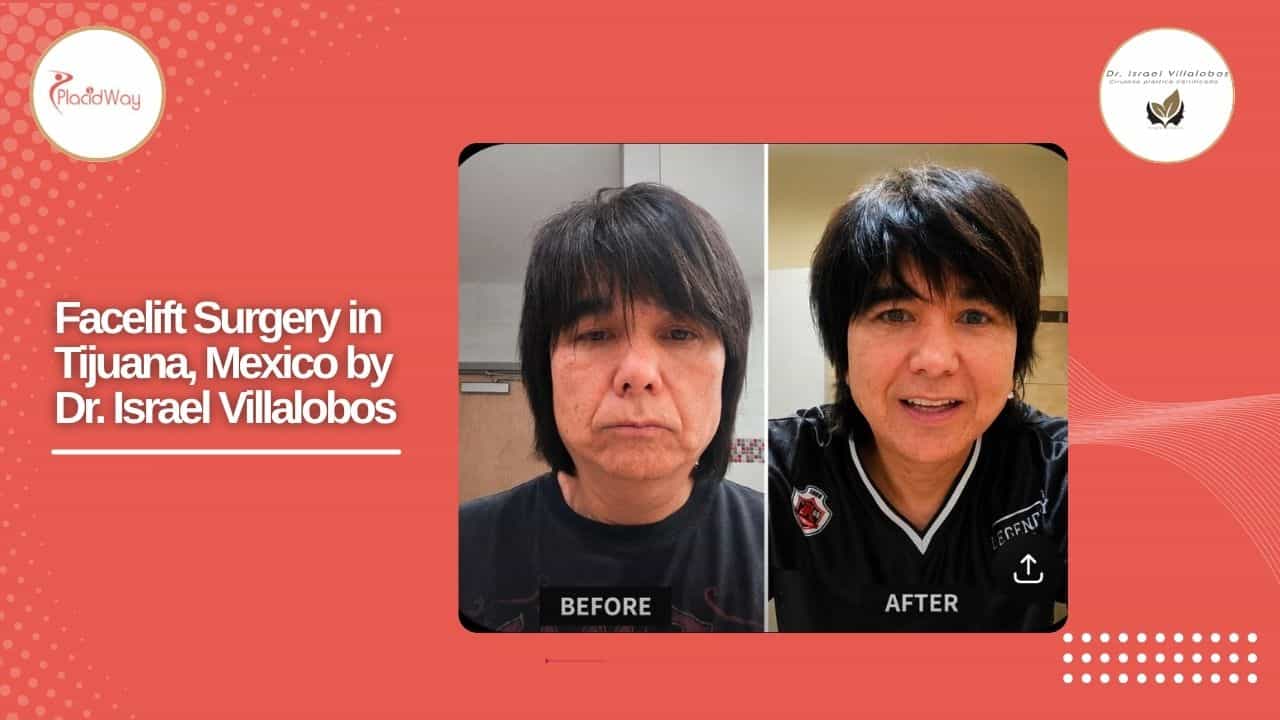 Facelift Before and After Result 7
