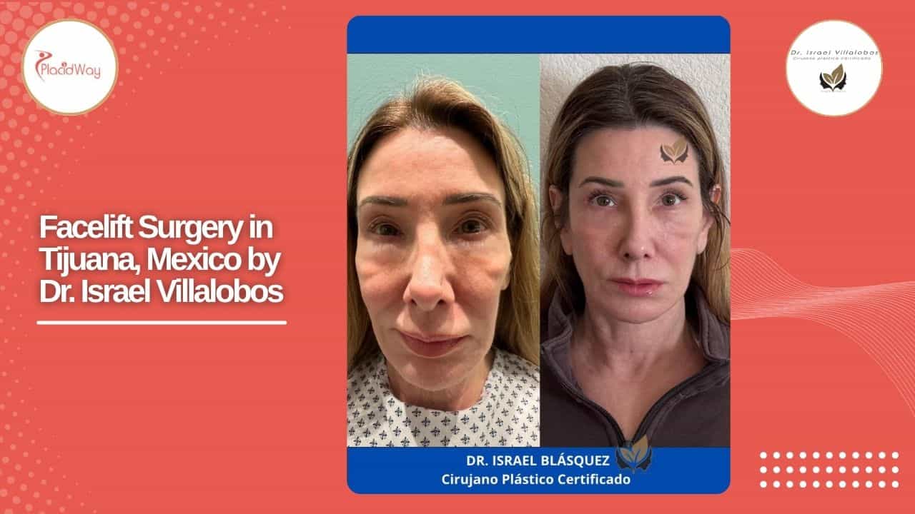 Facelift Before and After Result 8