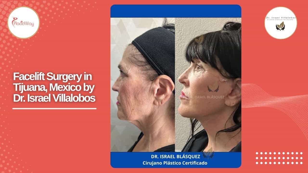 Facelift Before and After Result 9